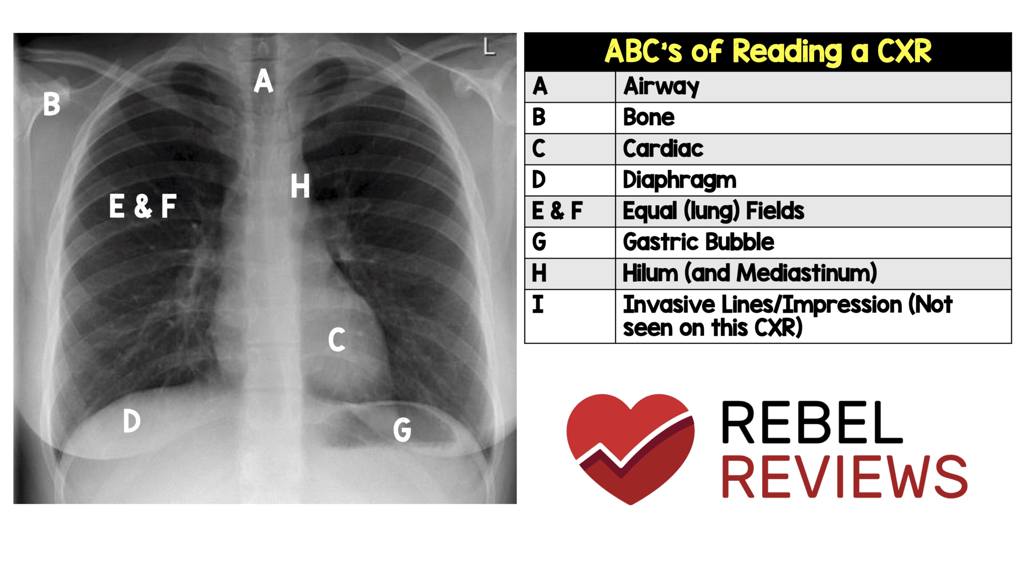 ABCs Of Reading A CXR REBEL EM Emergency Medicine Blog ABCs Of Reading A CXR REBEL EM Emergency Medicine Blog