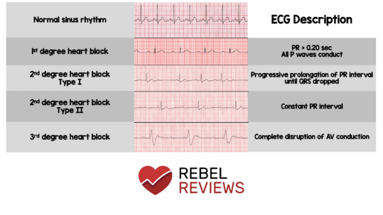 AV Heart Blocks - REBEL EM - Emergency Medicine Blog