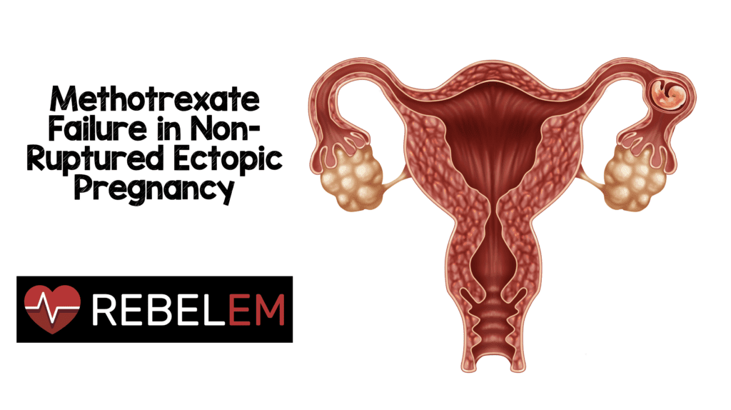 methotrexate-failure-in-non-ruptured-ectopic-pregnancy-rebel-em