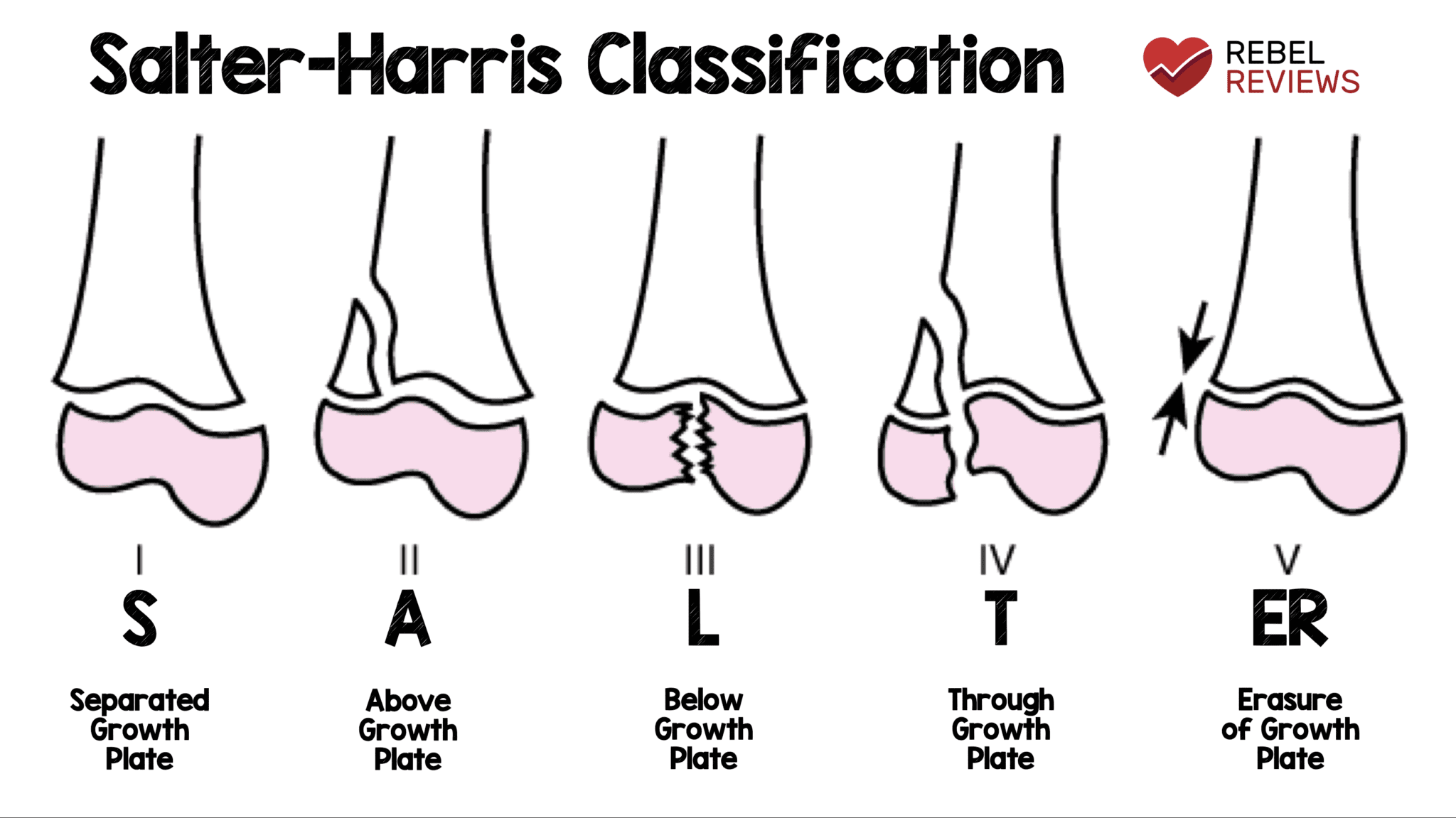 What are the 5 types of Salter-Harris fractures?