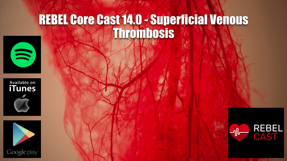 REBEL Core Cast 14.0 - Superficial Venous Thrombosis - REBEL EM - Emergency Medicine Blog