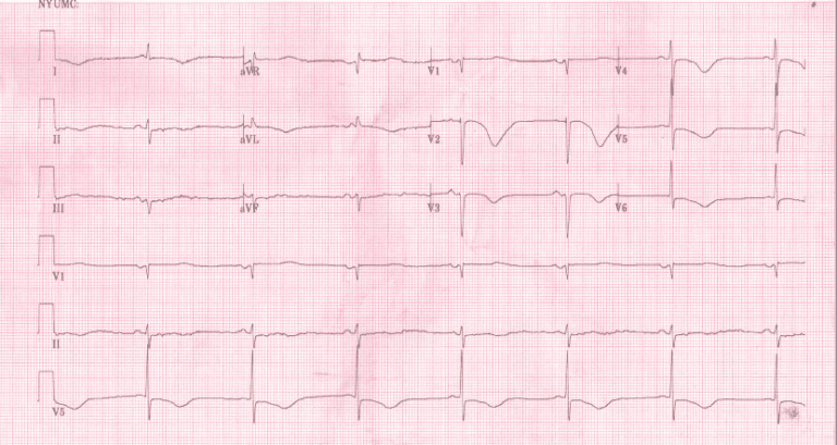 Prolonged QTc - REBEL EM - Emergency Medicine Blog