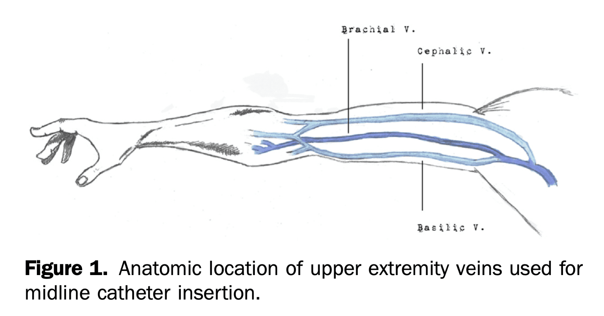 Midline IV Catheters REBEL EM Emergency Medicine Blog