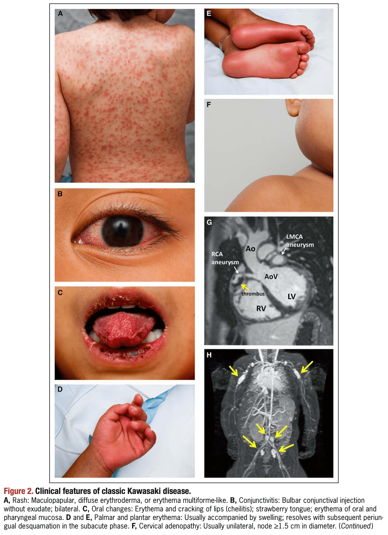 clinical presentation of kawasaki disease