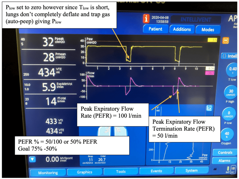 APRV Initial Settings REBEL EM Emergency Medicine Blog
