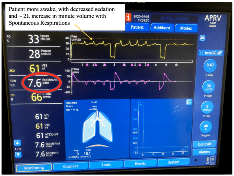 REBEL Crit Cast Ep3.0 Airway Pressure Release Ventilation (APRV) Made