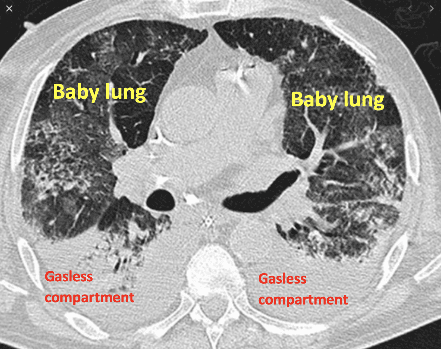 Baby Lungs - REBEL EM - Emergency Medicine Blog