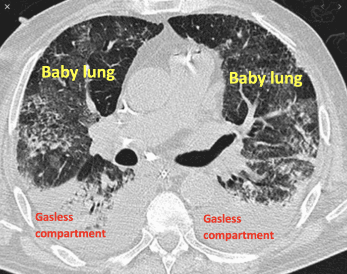 When Are Baby Lungs Fully Developed?