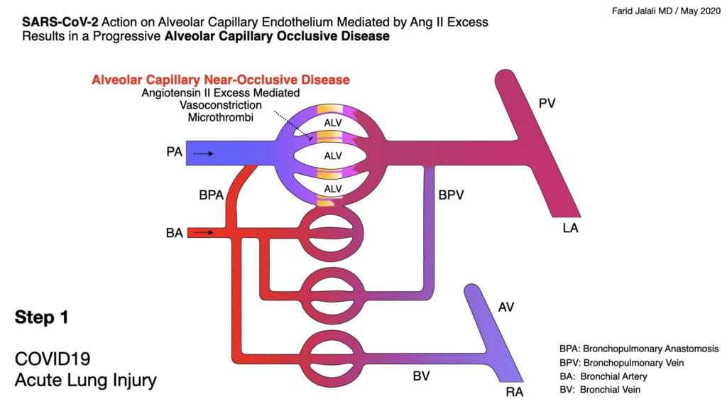 COVID19 Acute Lung Injury A Proposed Model (v1.0) via