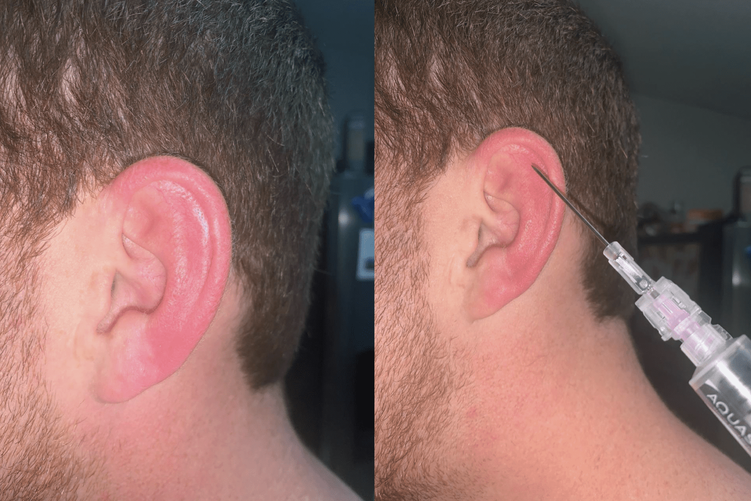 Sim Ear Practice Suturing Model - Realistic Auricular Laceration Trainer