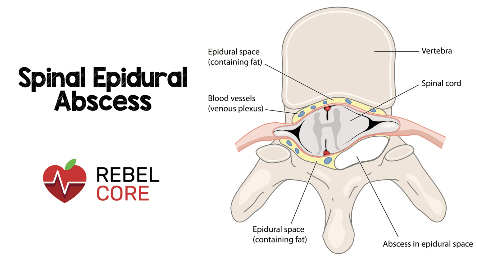 Spinal Epidural Abscess (SEA) REBEL EM Emergency Medicine Blog