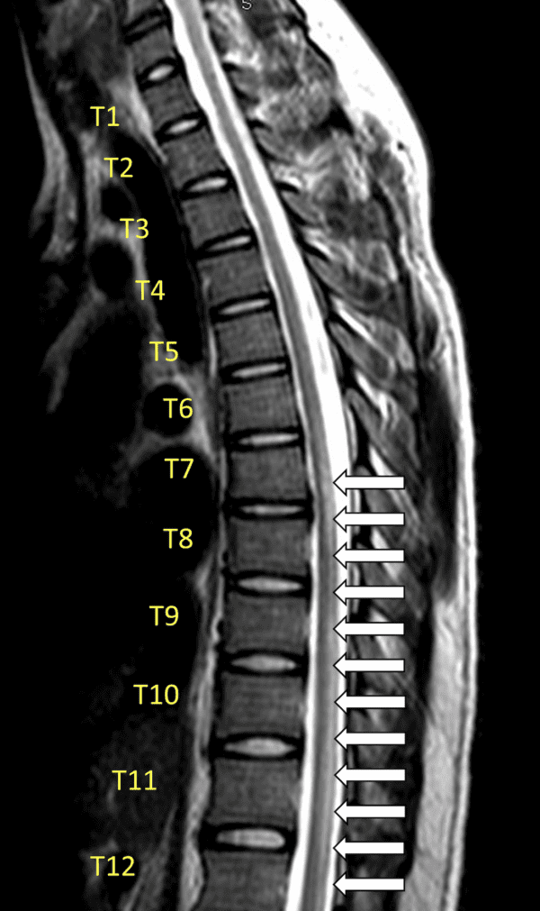 Infectious Acute Transverse Myelitis Secondary to COVID-19 - REBEL EM ...