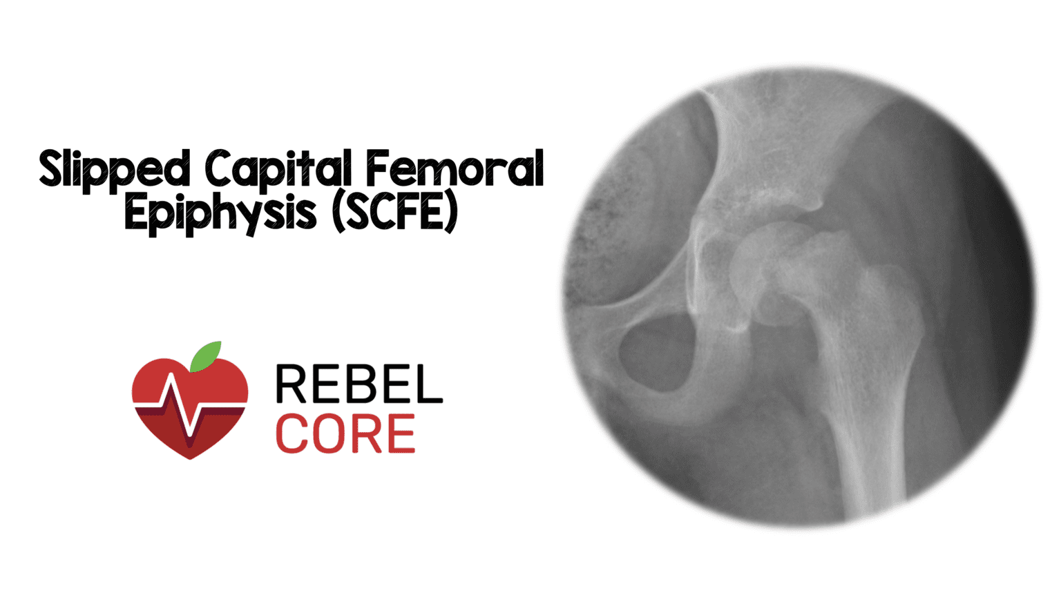 Slipped Capital Femoral Epiphysis (SCFE) - REBEL EM - Emergency ...