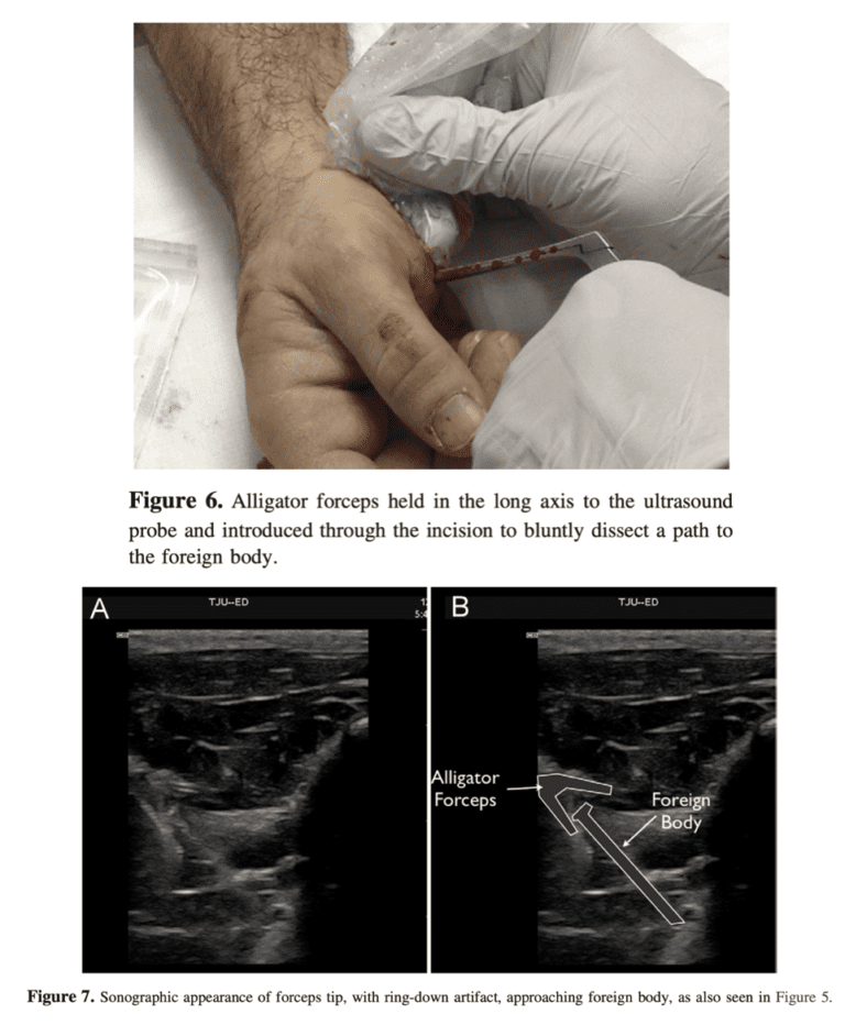 POCUS and Soft Tissue Foreign Bodies - REBEL EM - Emergency Medicine Blog