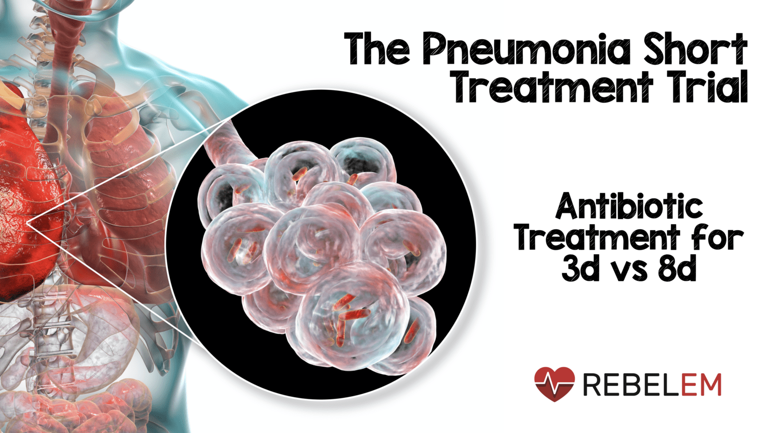 The Pneumonia Short Treatment Trial: Antibiotic Treatment for 3 days vs