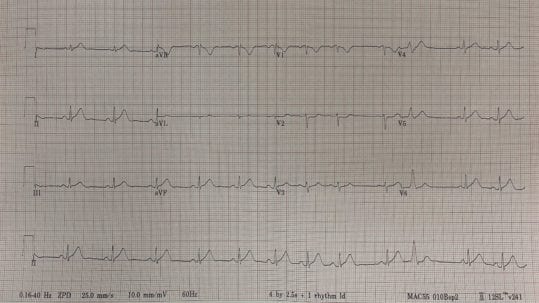 Chest Pain and Chemotherapy: 5-FU Induced Coronary Vasospasm - REBEL EM ...