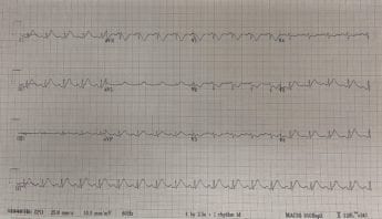 Chest Pain and Chemotherapy: 5-FU Induced Coronary Vasospasm - REBEL EM ...