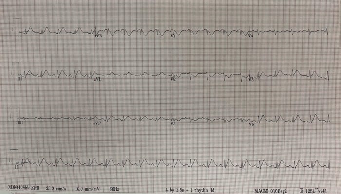 Chest Pain and Chemotherapy: 5-FU Induced Coronary Vasospasm - REBEL EM ...