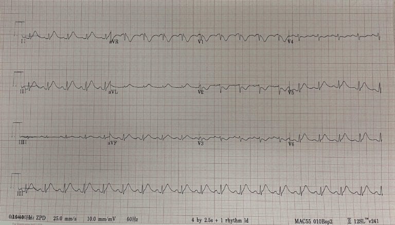 Chest Pain And Chemotherapy: 5-fu Induced Coronary Vasospasm - Rebel Em 