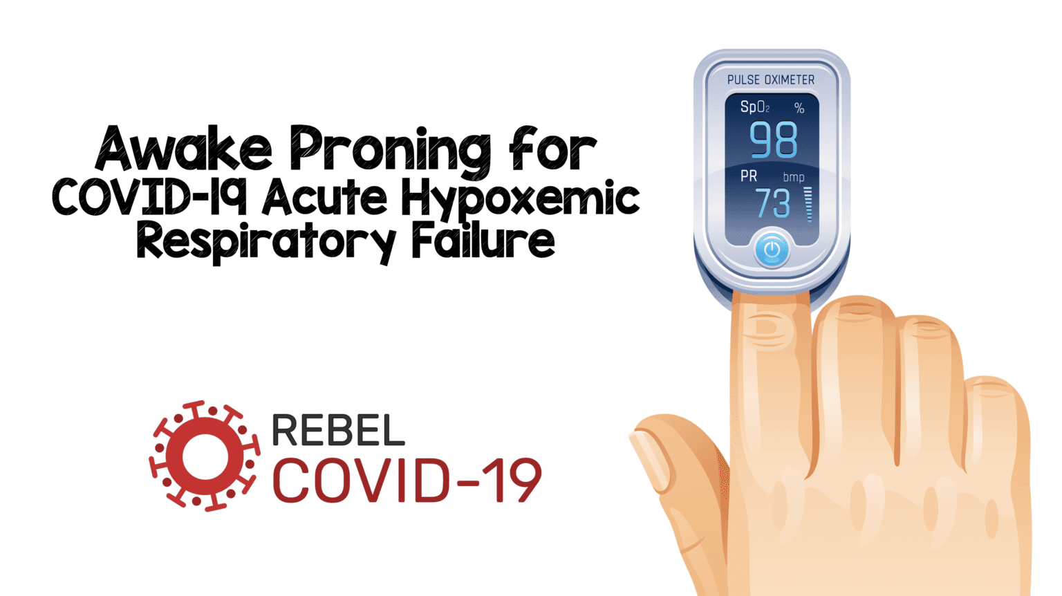 Awake Proning for COVID-19 Acute Hypoxemic Respiratory Failure - REBEL ...