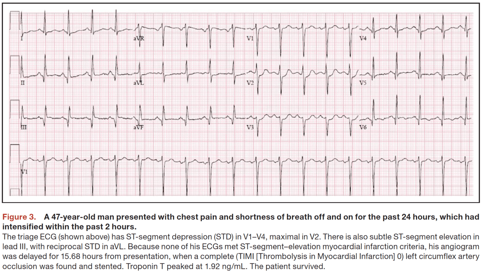 Posterior Occlusion Myocardial Infarctions and STDmaxV1-4 - REBEL EM ...