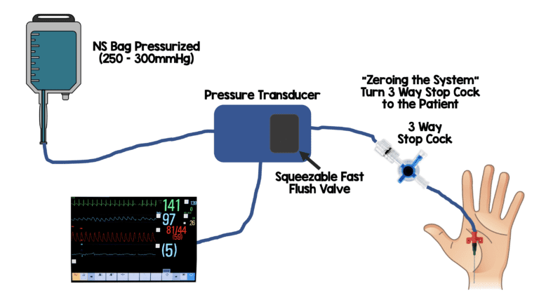 Damping and Arterial Lines - REBEL EM - Emergency Medicine Blog