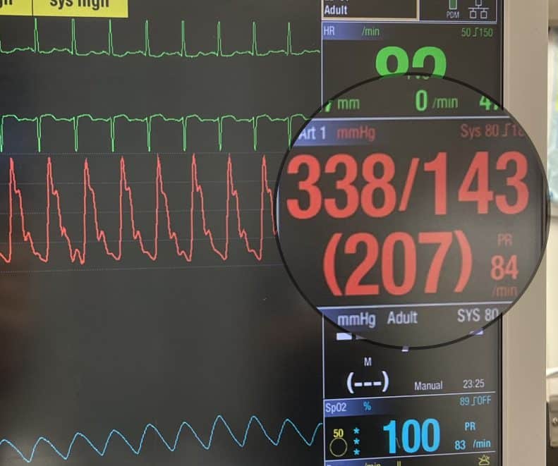 Damping And Arterial Lines REBEL EM Emergency Medicine Blog