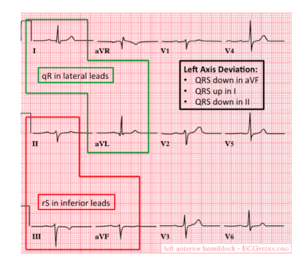 LAFB Annotated (REBEL EM) - REBEL EM - Emergency Medicine Blog