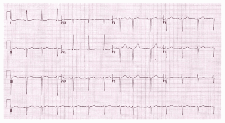 LAFB EKG (LITFL) - REBEL EM - Emergency Medicine Blog