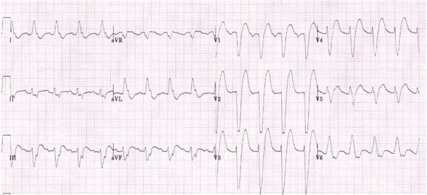 LBBB (LITFL) - REBEL EM - Emergency Medicine Blog