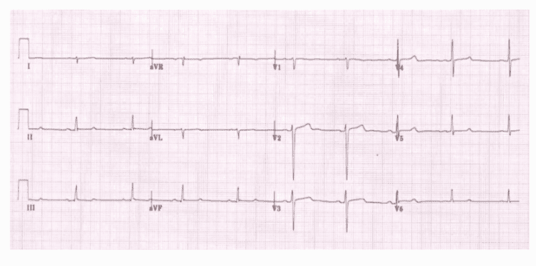 LPFB EKG (LITFL) - REBEL EM - Emergency Medicine Blog