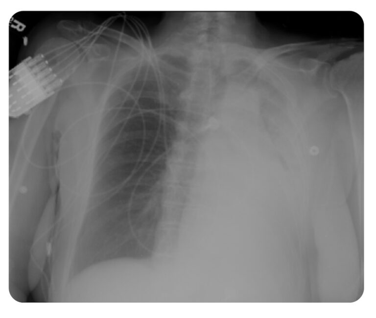 Rosh Mucus Plug CXR REBEL EM Emergency Medicine Blog